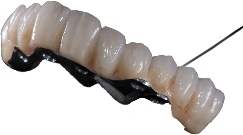 Bridge complet en zircone