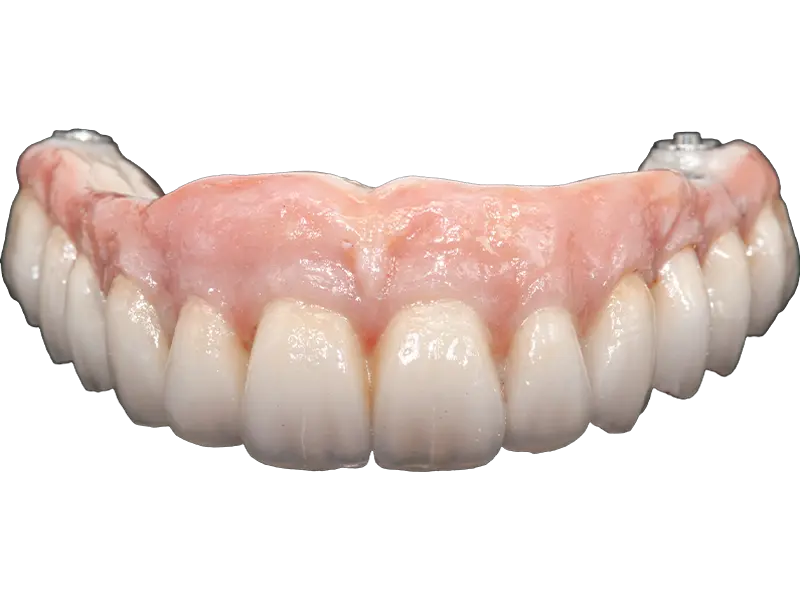 Bridge sur implants zircone
