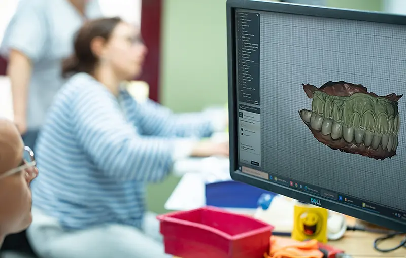 Conception numérique CAO d'une prothèse dentaire sur logiciel spécialisé pour garantir une occlusion parfaite.